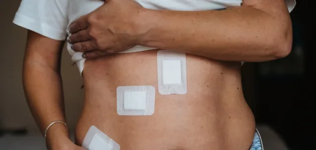 Cure de hernie IPOM